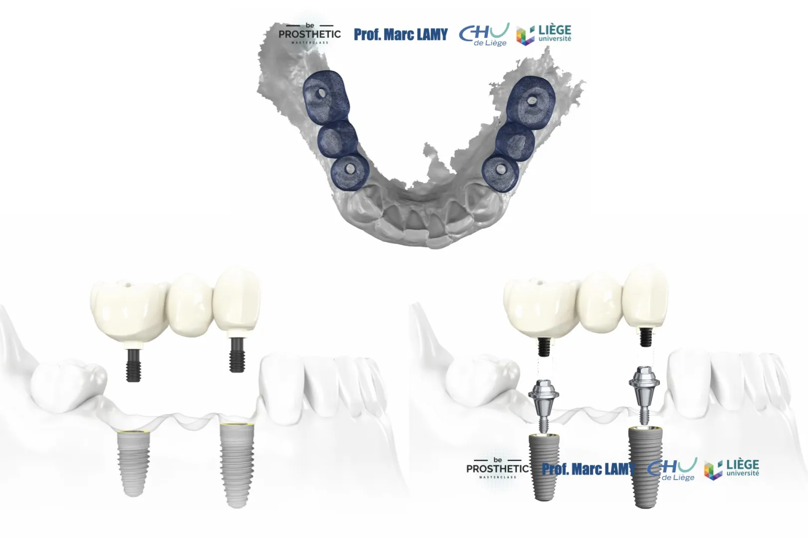 Pr Marc LAMY - Prothèse sur implants (BeProsthetic) - NOUVELLE EDITION