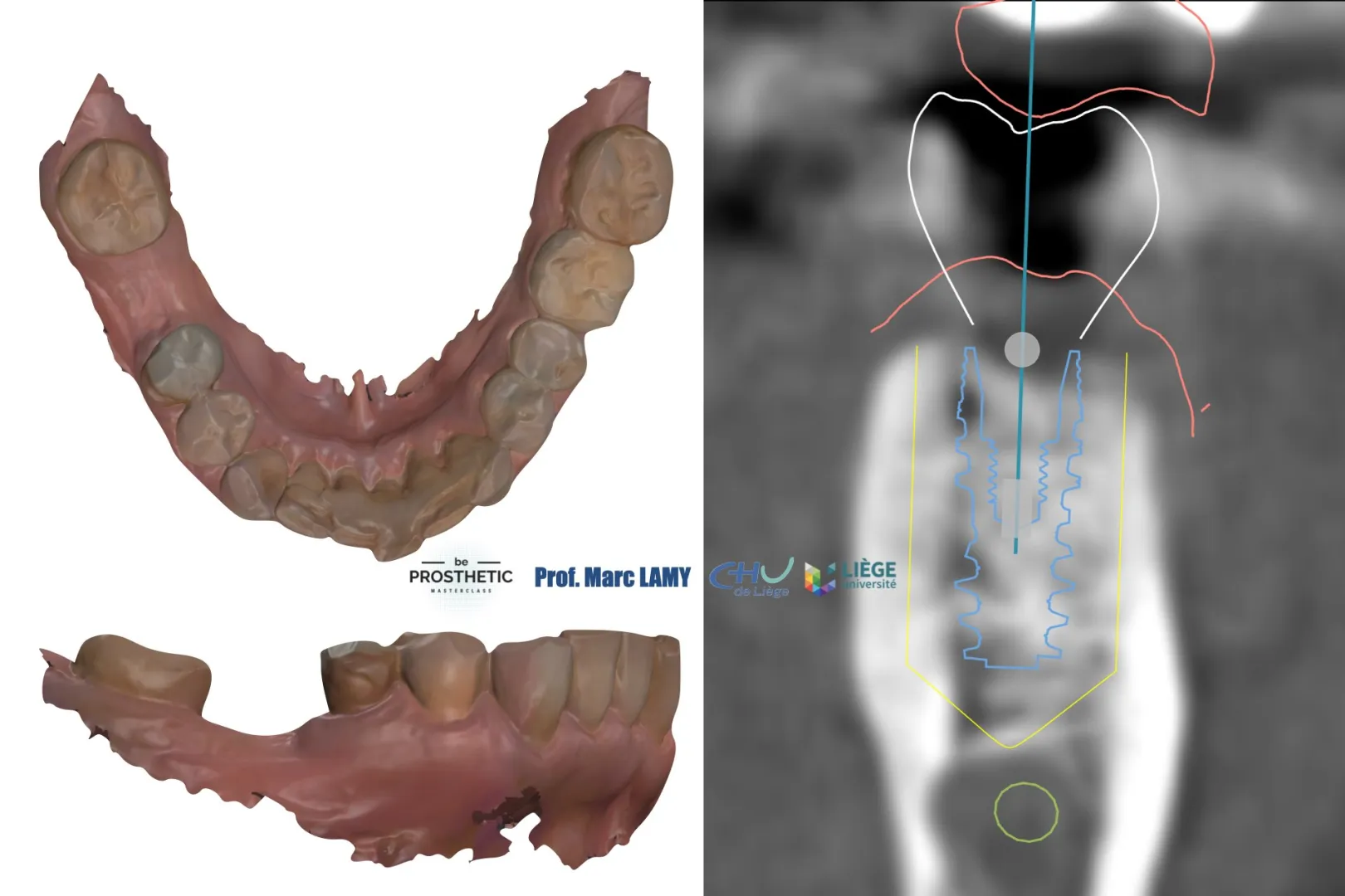 Pr Marc LAMY - Prothèse sur implants (BeProsthetic) - NOUVELLE EDITION