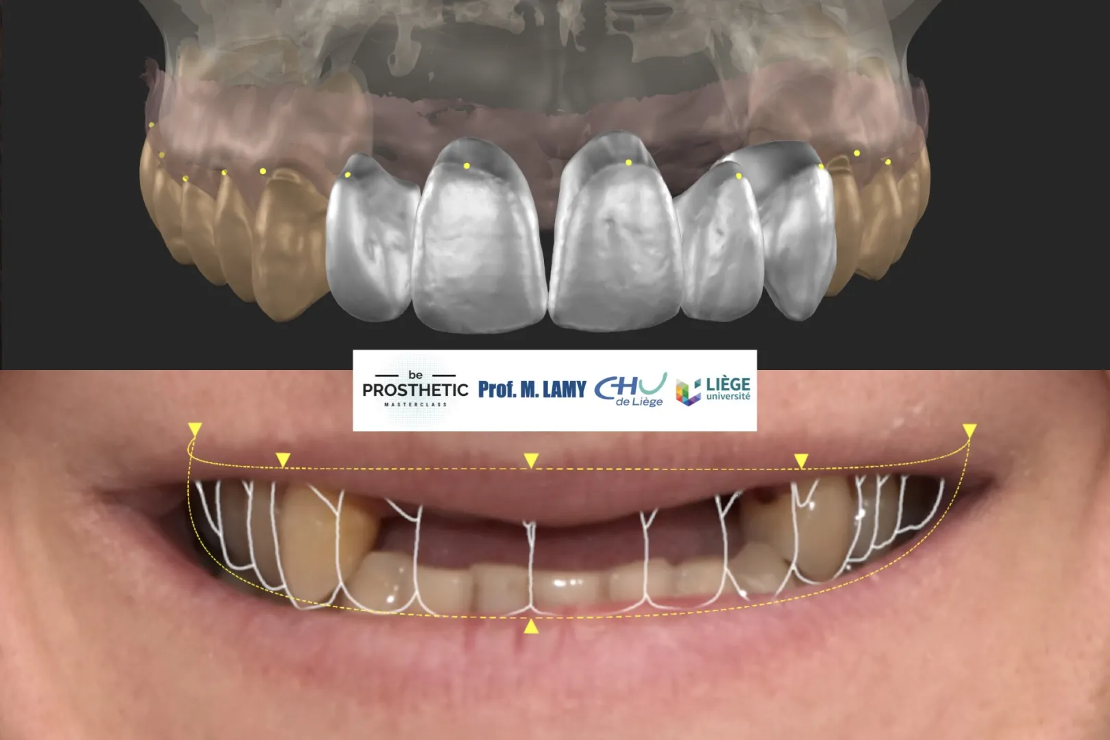 Pr Marc LAMY - Prothèse sur implants (BeProsthetic) - NOUVELLE EDITION