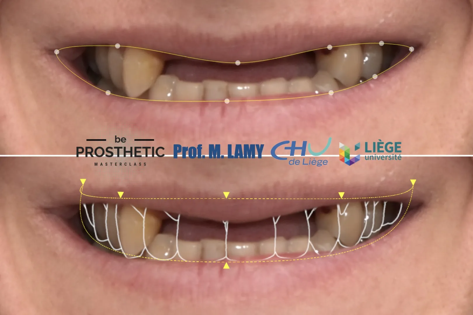 Pr Marc LAMY - Prothèse sur implants (BeProsthetic) - NOUVELLE EDITION
