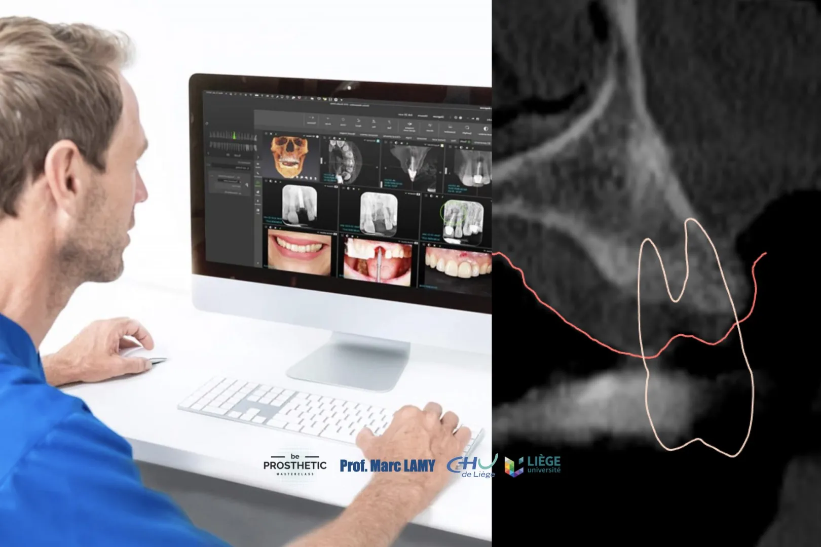 Pr Marc LAMY - Prothèse sur implants (BeProsthetic) - NOUVELLE EDITION