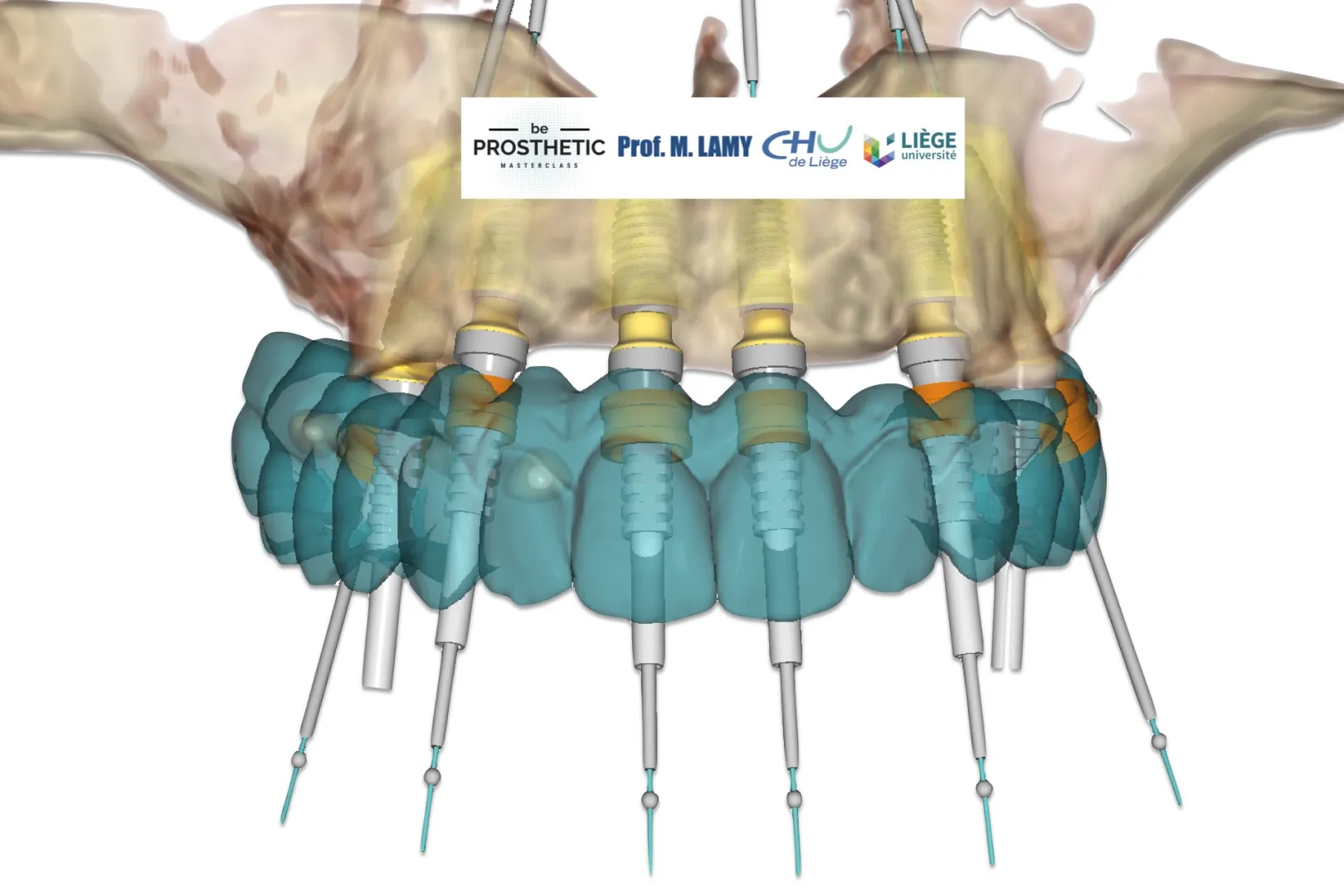 Pr Marc LAMY - Prothèse sur implants (BeProsthetic) - NOUVELLE EDITION