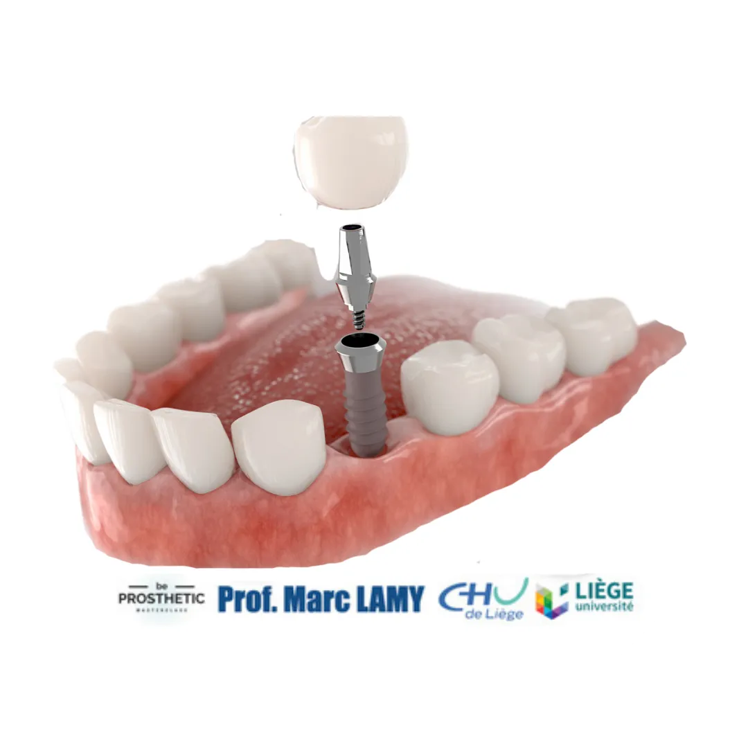 Pr Marc LAMY - Prothèse sur implants (BeProsthetic) - NOUVELLE EDITION