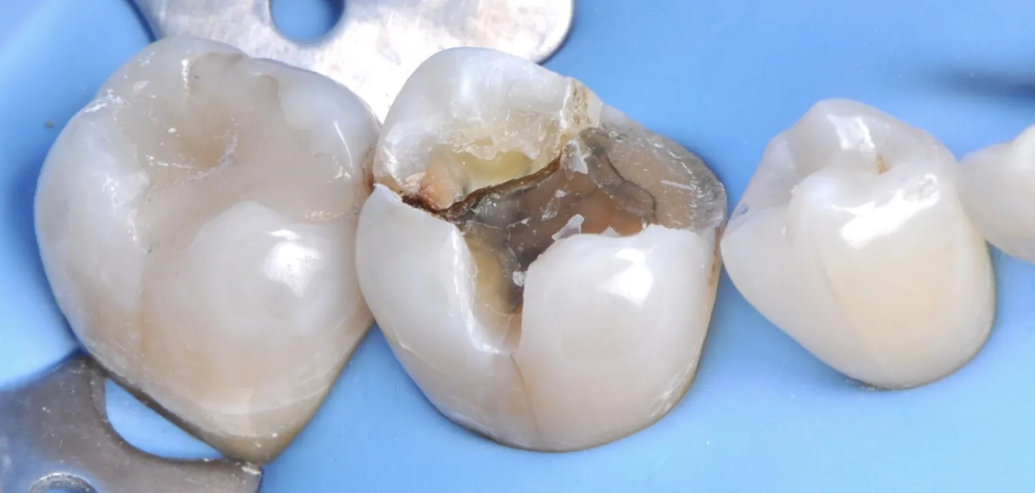 Que faire des félures ? Invasivité minimum ou risque minimum ?