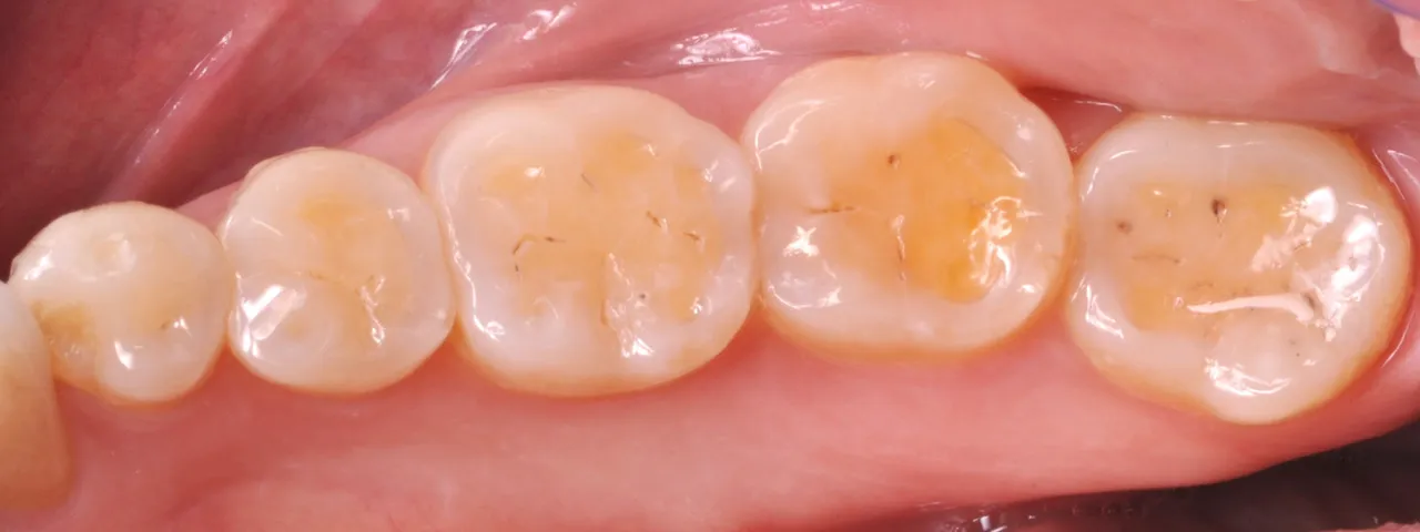 Dr Romain CHERON - Les composites postérieurs : tout contrôler pour tout simplifier