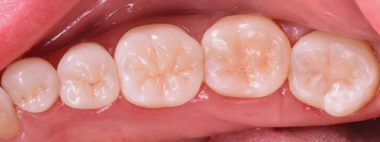 Dr Romain CHERON - Les composites postérieurs : tout contrôler pour tout simplifier