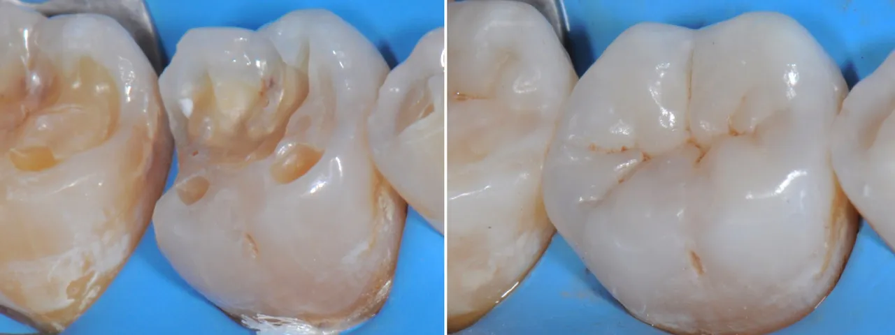 Dr Romain CHERON - Les composites postérieurs : tout contrôler pour tout simplifier