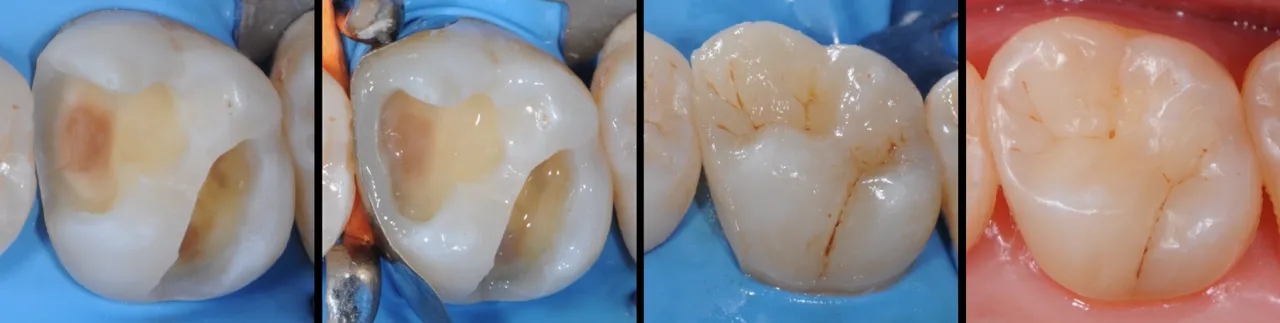 Dr Romain CHERON - Les composites postérieurs : tout contrôler pour tout simplifier