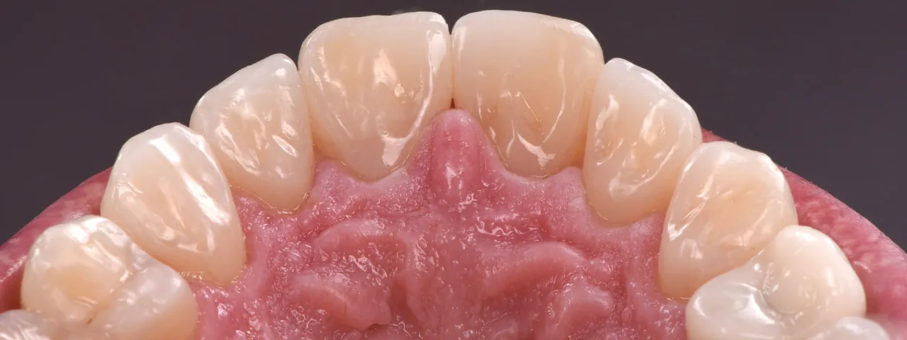 Dr Romain CHERON - Les composites postérieurs : tout contrôler pour tout simplifier