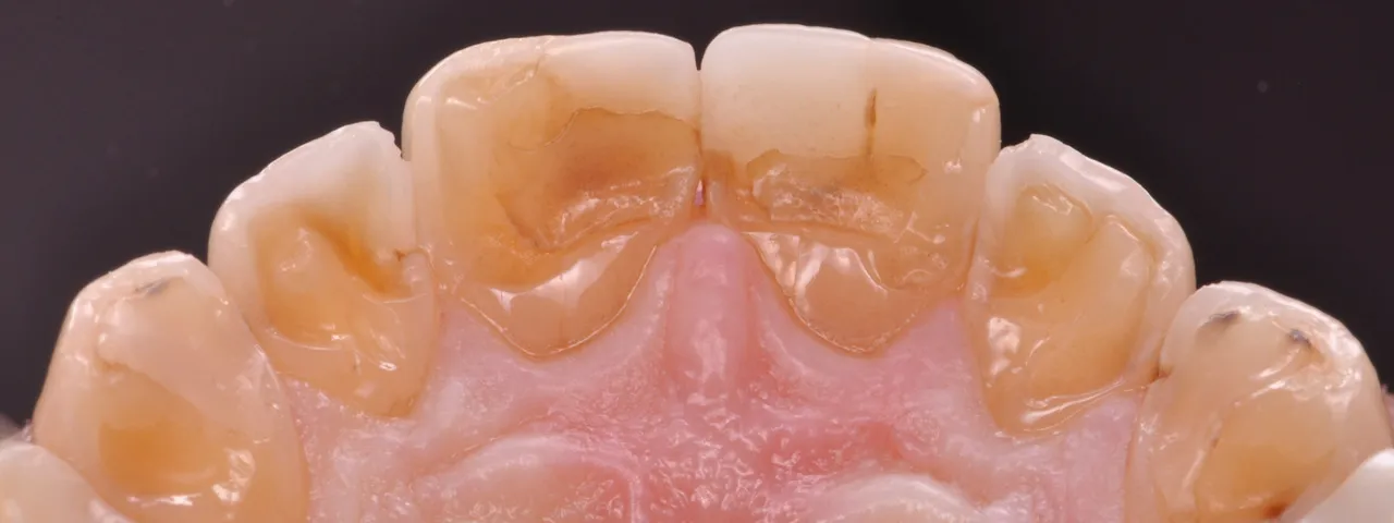 Dr Romain CHERON - Les composites postérieurs : tout contrôler pour tout simplifier