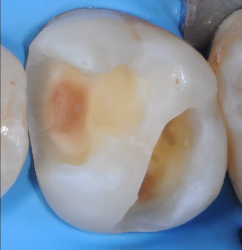 Dr Romain CHERON - Les composites postérieurs : tout contrôler pour tout simplifier