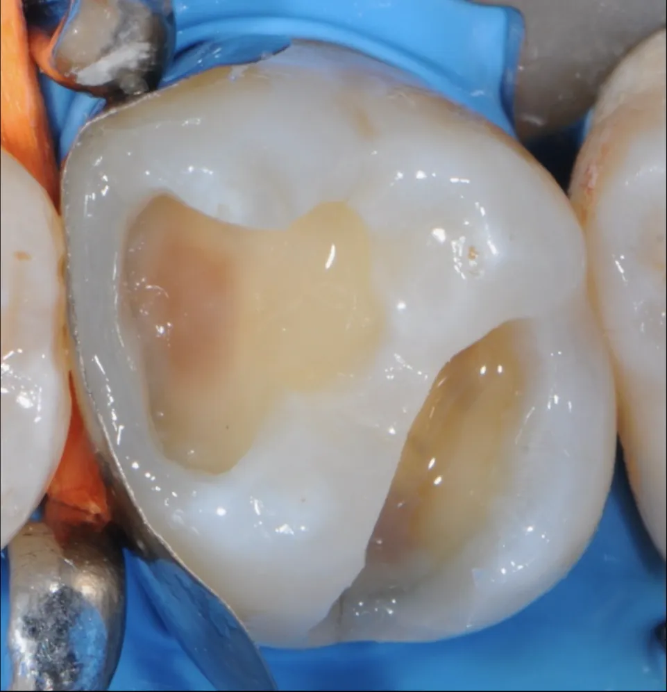 Dr Romain CHERON - Les composites postérieurs : tout contrôler pour tout simplifier