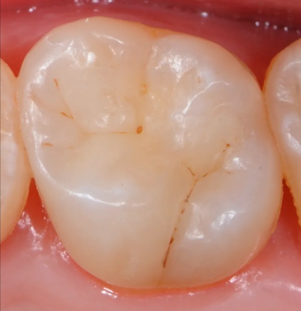 Dr Romain CHERON - Les composites postérieurs : tout contrôler pour tout simplifier