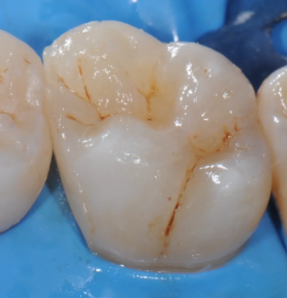 Dr Romain CHERON - Les composites postérieurs : tout contrôler pour tout simplifier